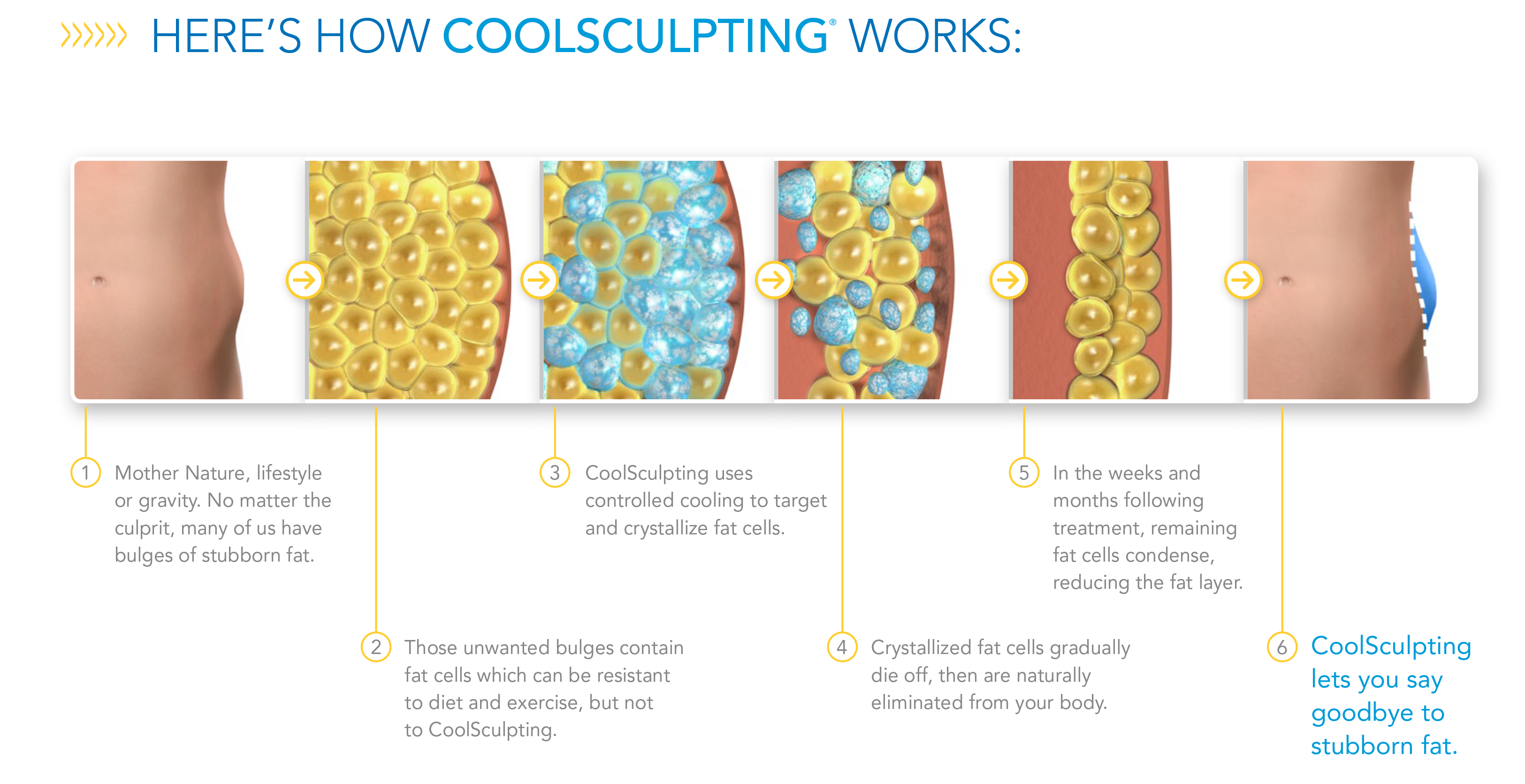 How Coolsculpting works