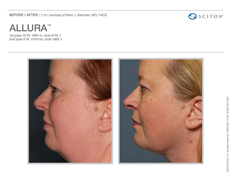 Sciton Allura Laser Lipo Columbus, OH Fat Reduction Gahanna