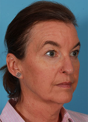 Skin Cancer Reconstruction