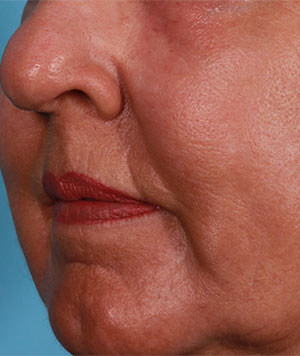 Fractional CO2 Laser Resurfacing Before and After Results