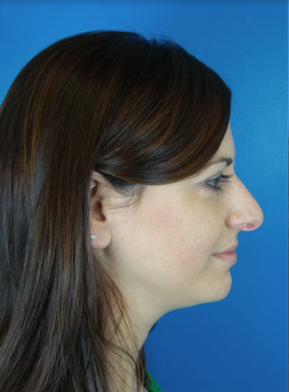 Rhinoplasty