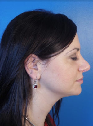 Rhinoplasty