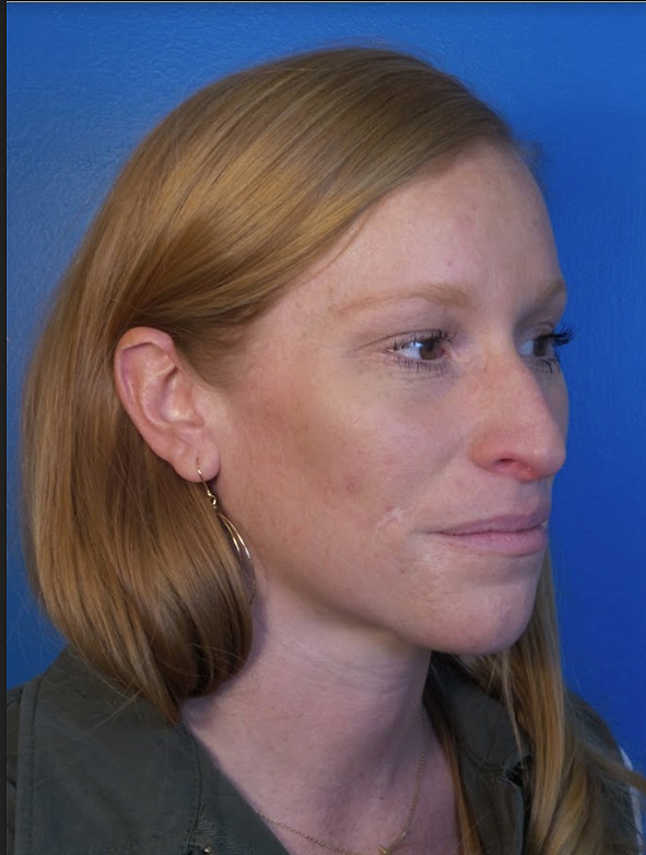 Rhinoplasty