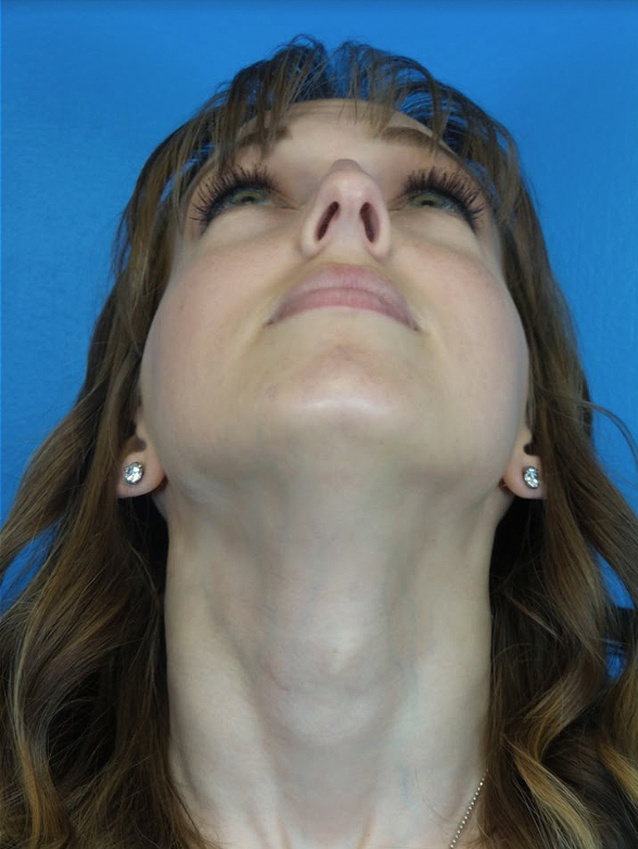 Rhinoplasty