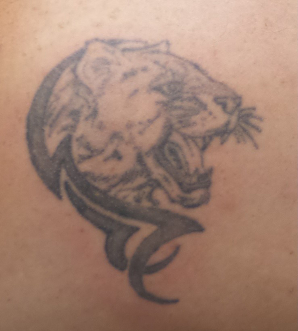 Laser Tattoo Removal