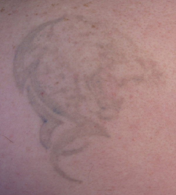 Laser Tattoo Removal