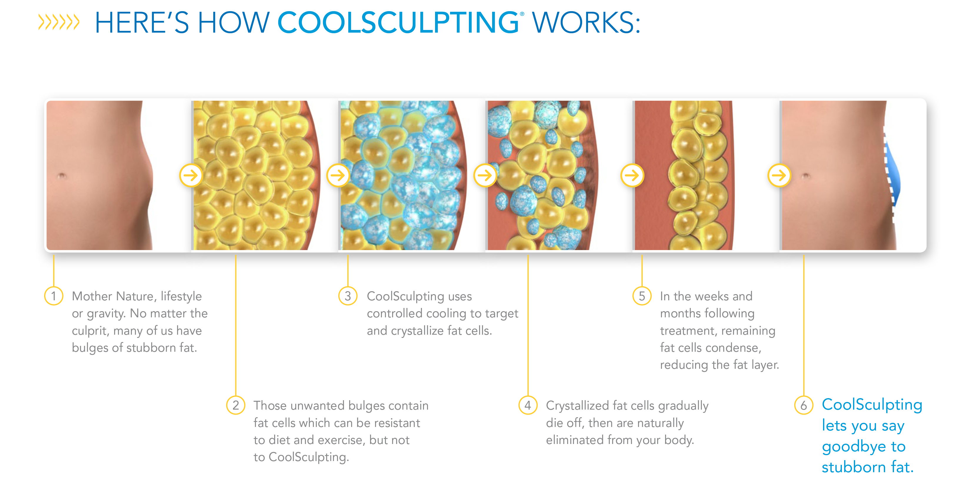 How Coolsculpting works