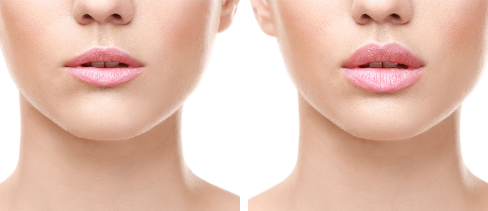 How To Tell If Someone Has Lip Fillers? 