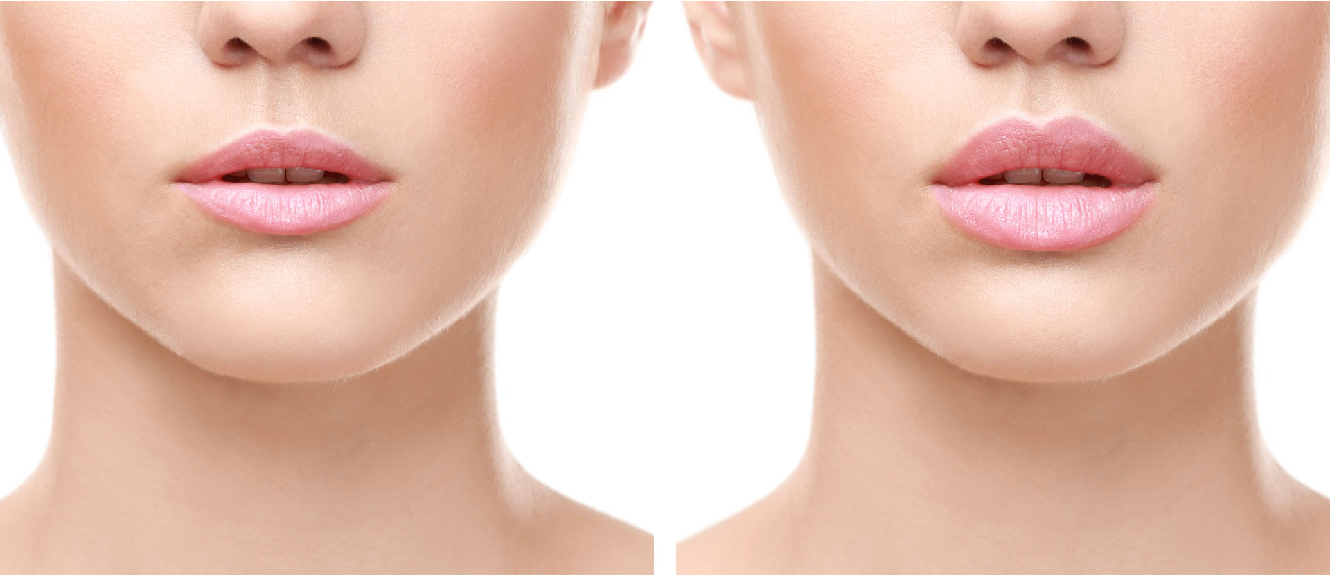 How To Tell If Someone Has Lip Fillers?