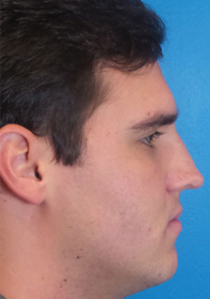 Rhinoplasty