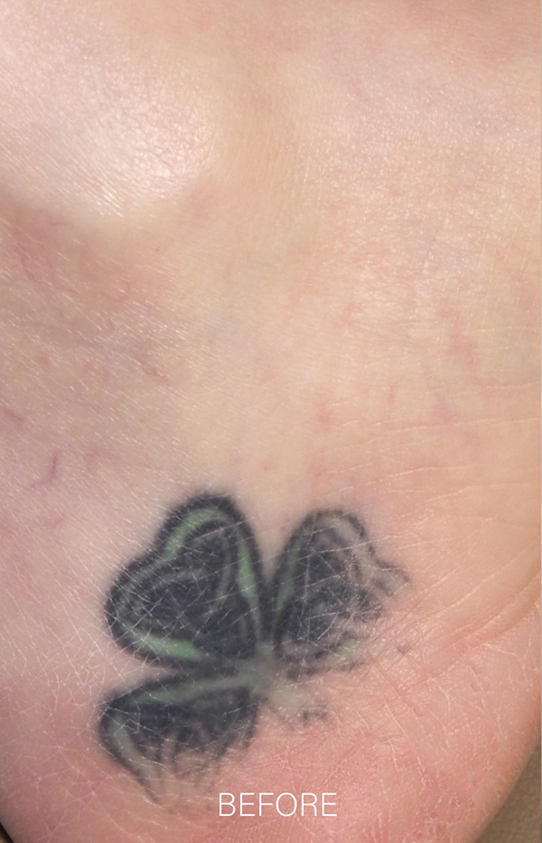Laser Tattoo Removal