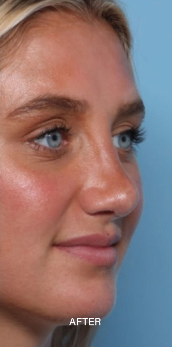 Rhinoplasty