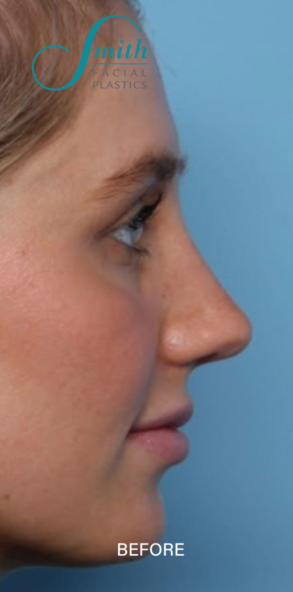 Rhinoplasty