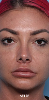 Lip Augmentation