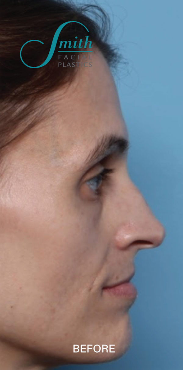 Rhinoplasty