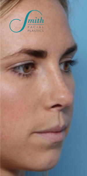 Rhinoplasty