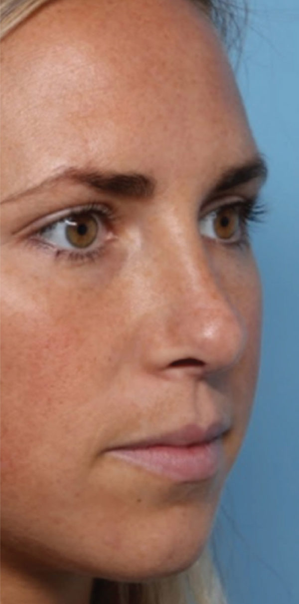 Rhinoplasty