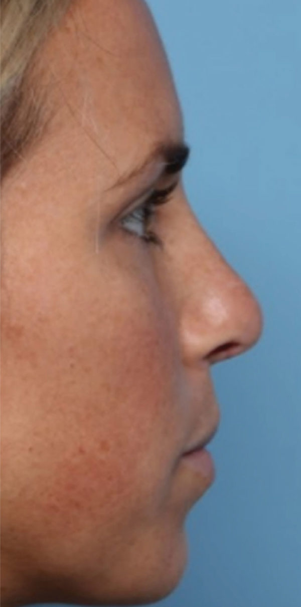 Rhinoplasty