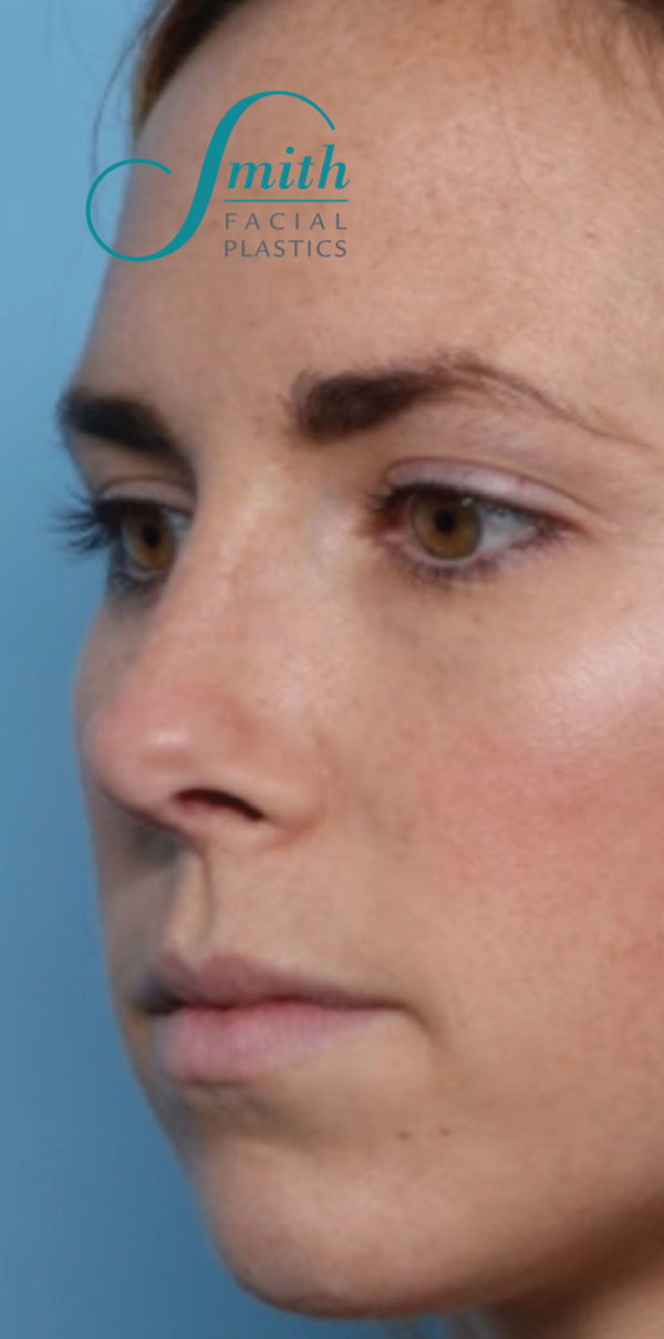 Rhinoplasty