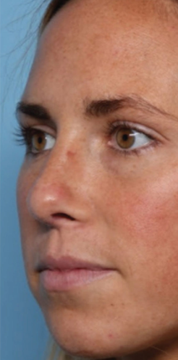 Rhinoplasty