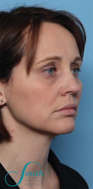 Rhinoplasty