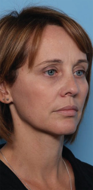 Rhinoplasty