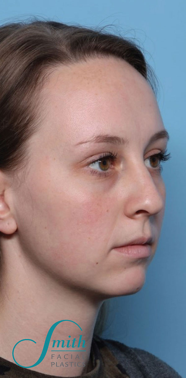 Rhinoplasty