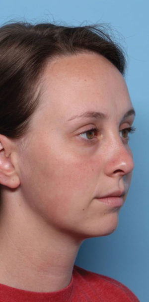 Rhinoplasty