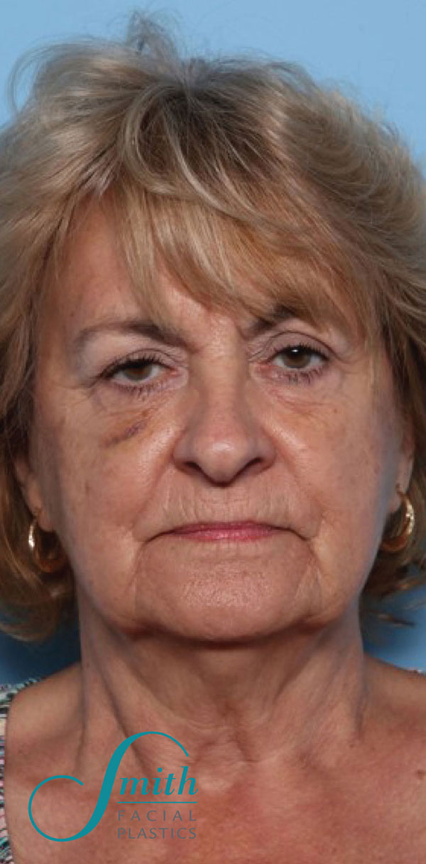 Facelift
