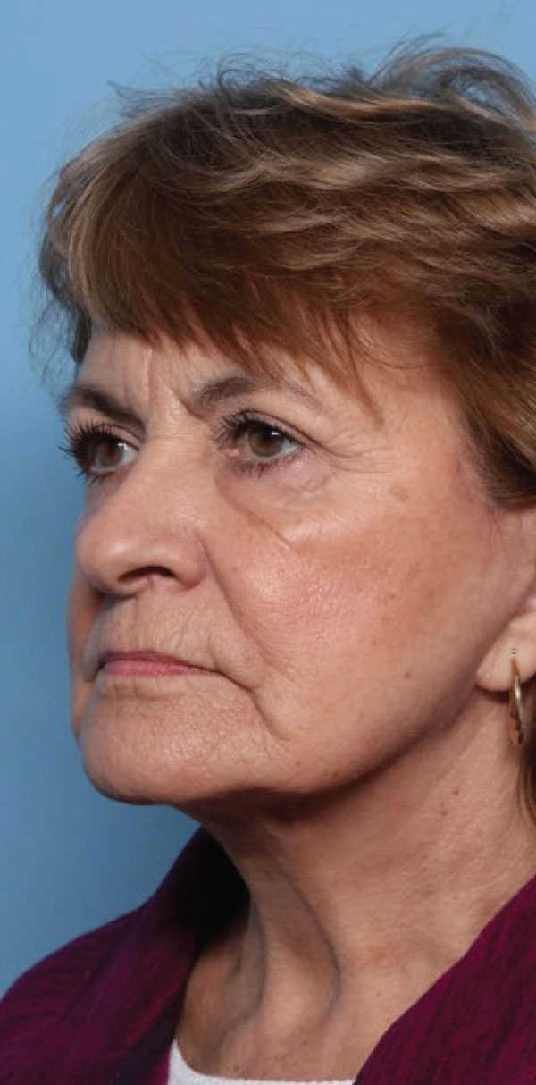 Facelift