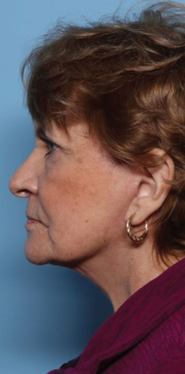 Facelift