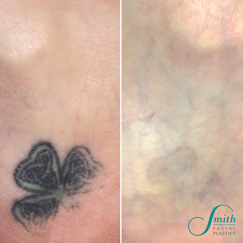 Laser Tattoo Removal Before and After Results in Columbus by Smith Facial Plastics