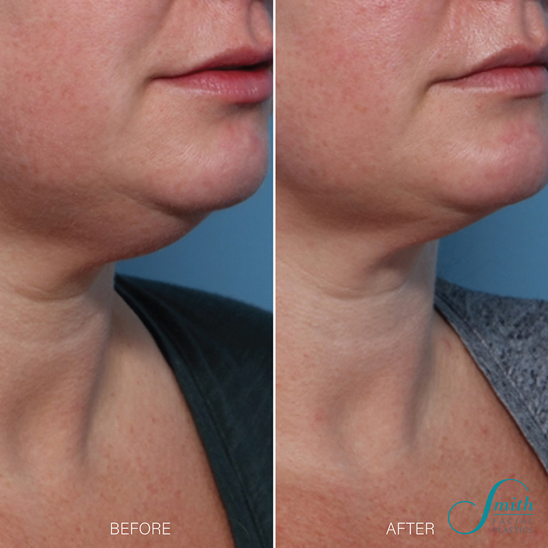 Kybella before and afters in Columbus by Smith Facial Plastics