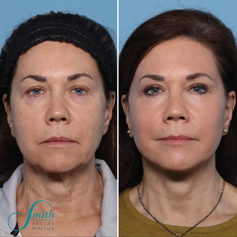 Facelift Before and After Results in Columbus by Smith Facial Plastics