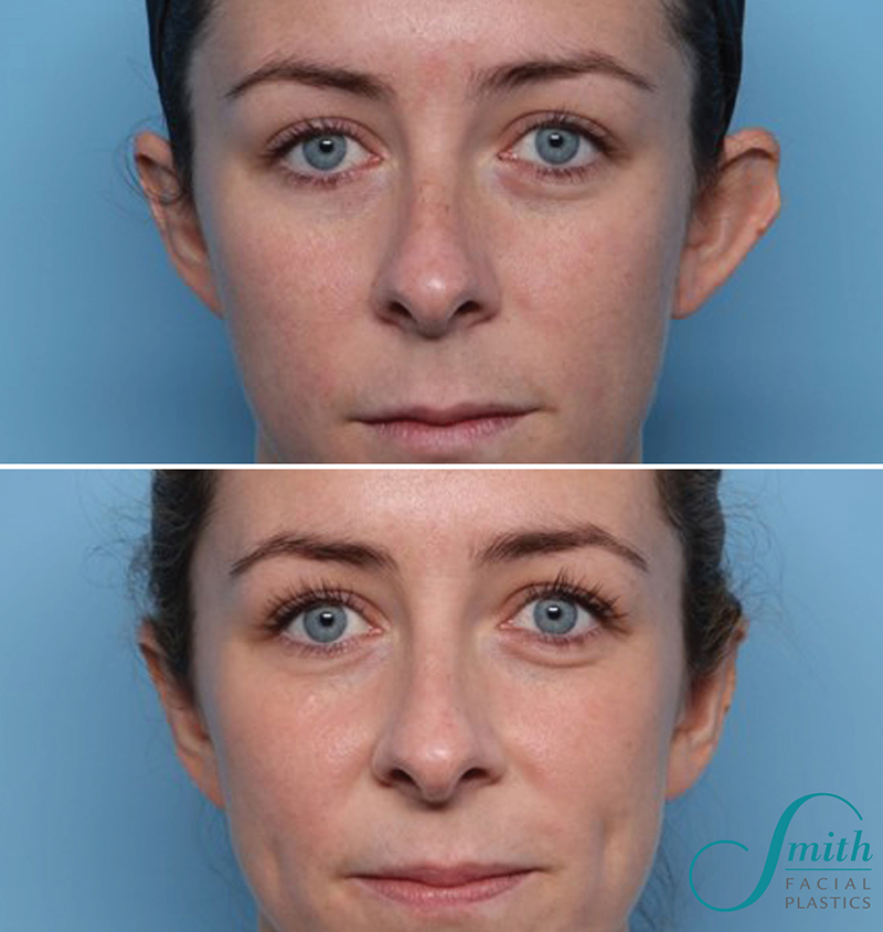 Otoplasty Before and After Results in Columbus by Smith Facial Plastics