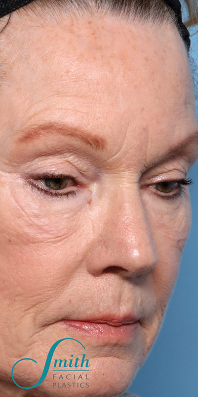 Blepharoplasty