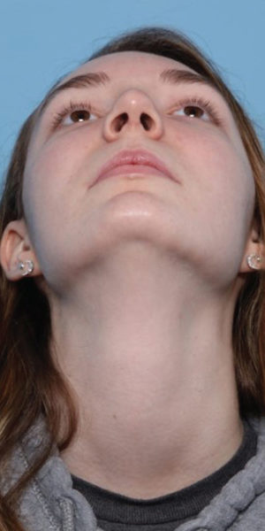 Rhinoplasty