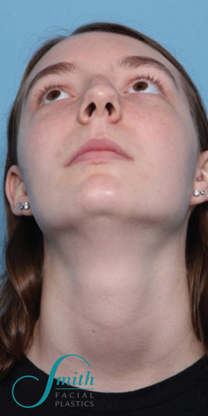 Rhinoplasty