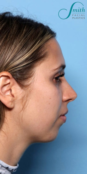 Chin Augmentation