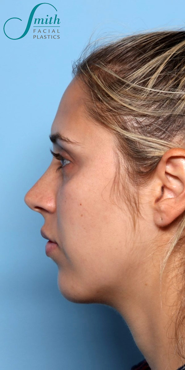 Chin Augmentation