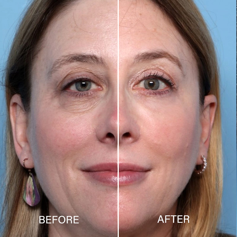 Before and after photo of eyelid (Blepharoplasty) surgery results