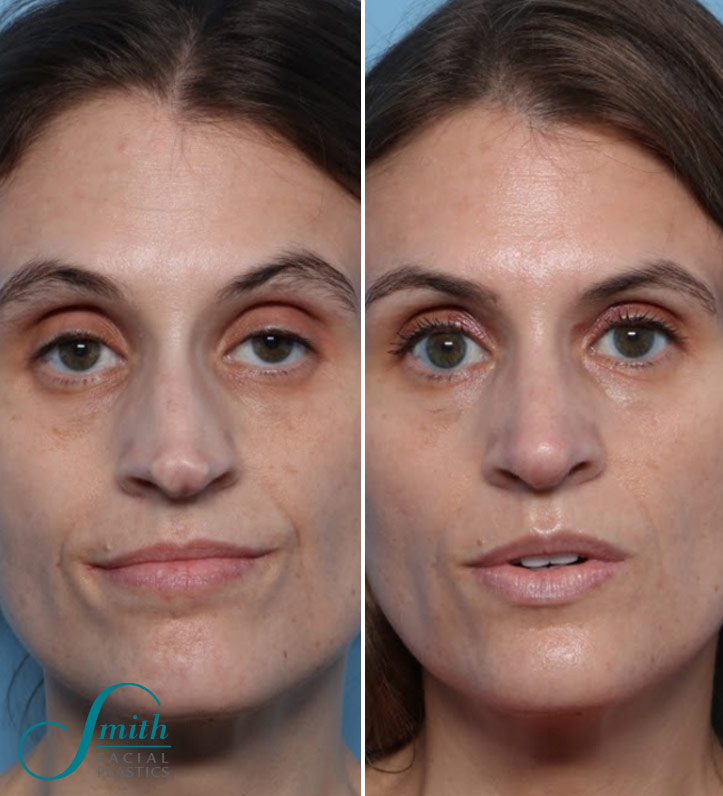 Rhinoplasty Before and After Results in Columbus by Smith Facial Plastics