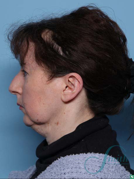 Chin Augmentation