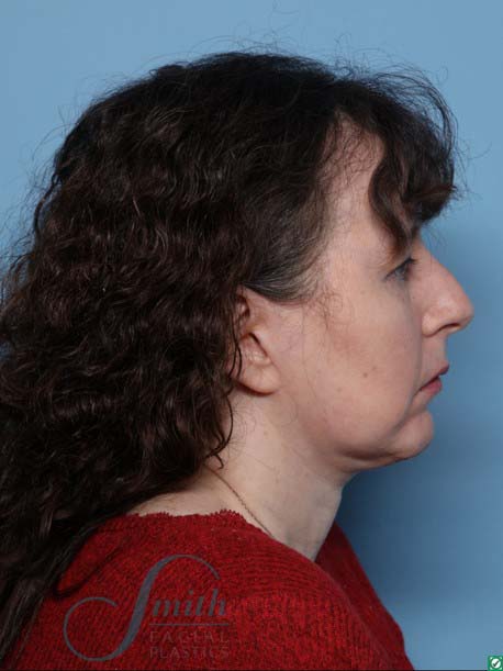 Chin Augmentation