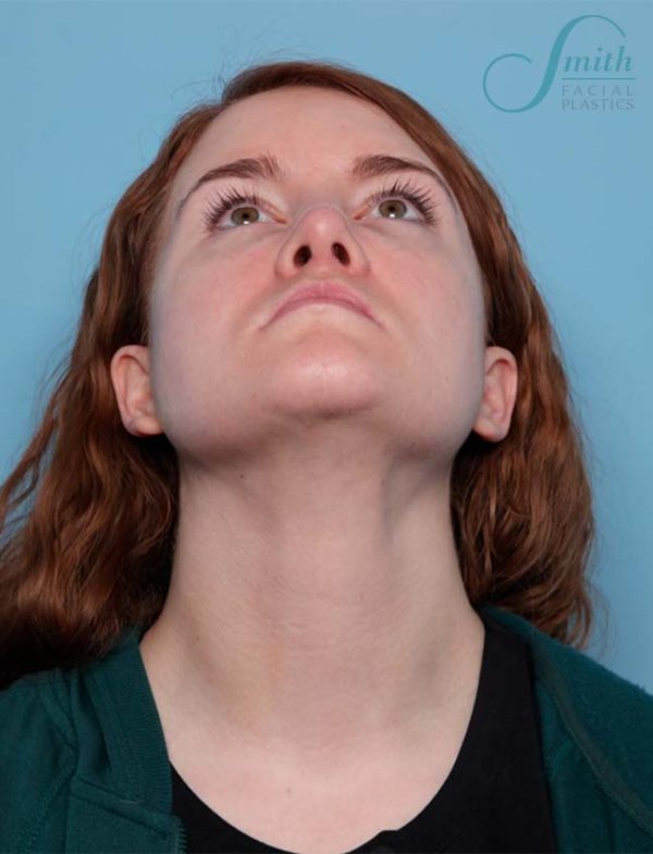 Neck Liposuction