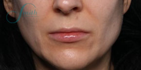 Lip Augmentation