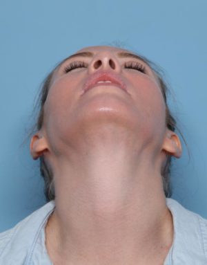 Rhinoplasty