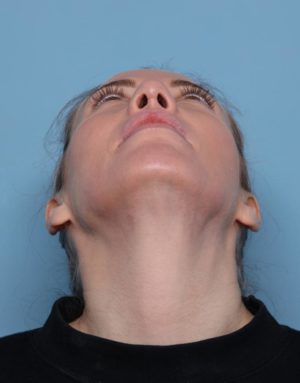 Rhinoplasty