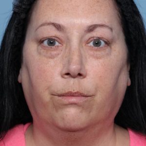 Blepharoplasty