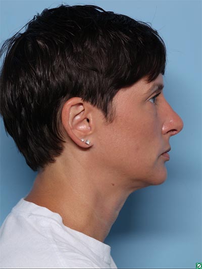 Rhinoplasty